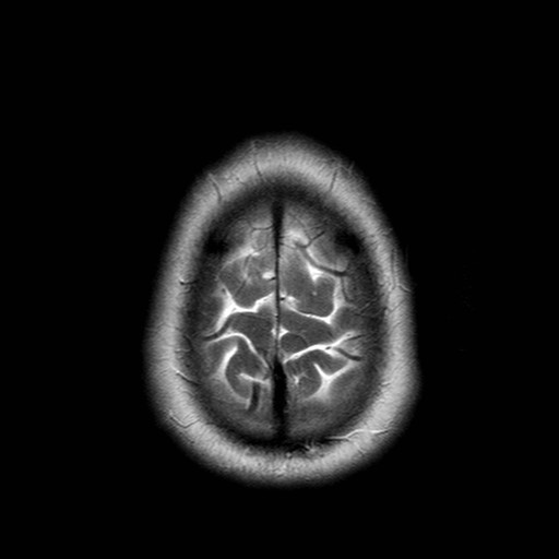 File:Neuro-Behcet's disease (Radiopaedia 21557-21505 Axial T2 21).jpg