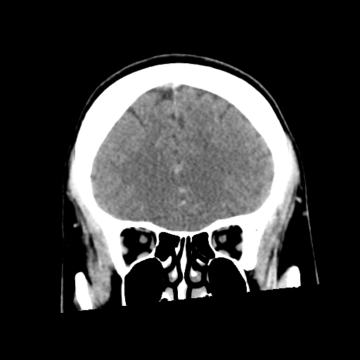 Neurocysticercosis - granular nodular (Radiopaedia 42786-45957 Coronal C+ 19).png