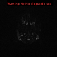 File:Neurofibromatosis type 1 with optic nerve glioma (Radiopaedia 16288-15965 Axial DWI 47).jpg