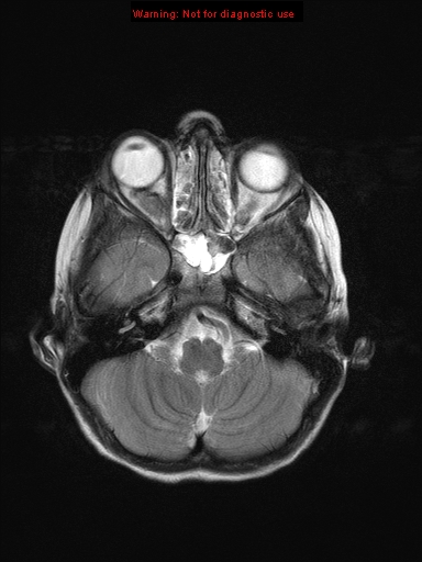 File:Neurofibromatosis type 1 with optic nerve glioma (Radiopaedia 16288-15965 Axial T2 20).jpg