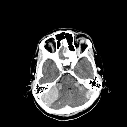 File:Neurofibromatosis type 2 (Radiopaedia 25389-25637 Axial C+ 20).jpg