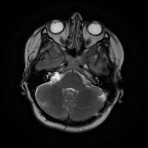 File:Neurofibromatosis type 2 (Radiopaedia 45229-49247 Axial T2 6).png