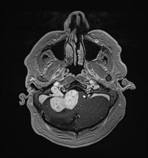 Neurofibromatosis type 2 (Radiopaedia 79097-92049 Axial T1 C+ 41).jpg
