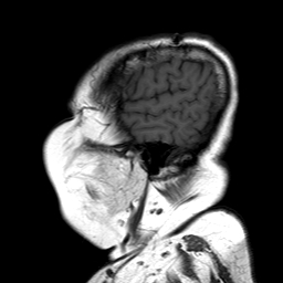 File:Neurofibromatosis type 2 (Radiopaedia 8713-9518 Sagittal T1 18).jpg