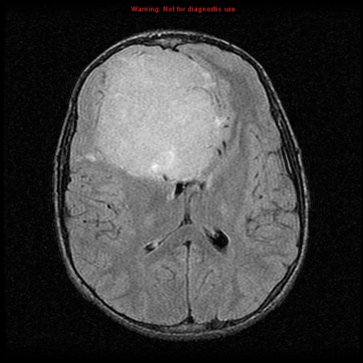 File:Neurofibromatosis type 2 (Radiopaedia 8953-9730 Axial FLAIR 15).jpg