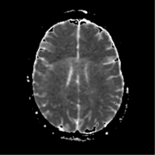 File:Neurofibromatosis type 2 - bilateral acoustic neuromata (Radiopaedia 40060-42566 Axial ADC 14).png