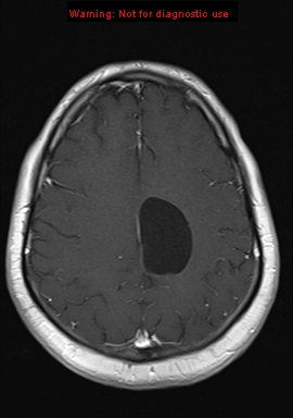 File:Neuroglial cyst (Radiopaedia 10713-11184 Axial T1 C+ 7).jpg