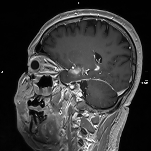 Neurosarcoidosis - involvement of the mesial temporal lobes (Radiopaedia 67429-76820 Sagittal T1 C+ 108).jpg