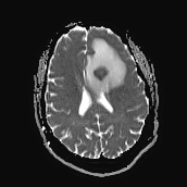 File:Neurotoxoplasmosis - concentric target sign (Radiopaedia 70644-80784 Axial ADC 14).jpg
