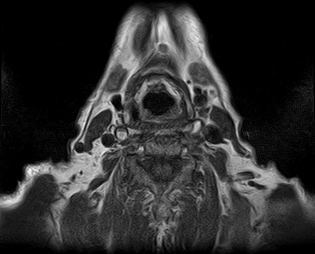 File:Non-Hodgkin lymphoma - parotid gland (Radiopaedia 71531-81890 Axial T1 2).jpg