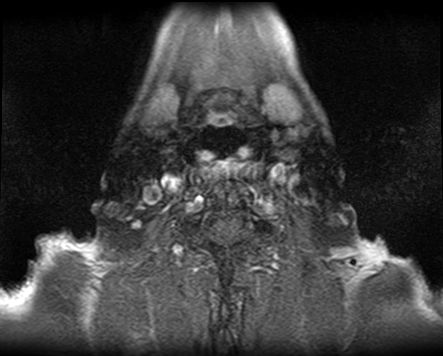 File:Non-Hodgkin lymphoma - parotid gland (Radiopaedia 71531-81890 Axial T1 C+ fat sat 3).jpg
