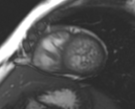 File:Non-compaction of the left ventricle (Radiopaedia 69436-79314 Short axis cine 82).jpg