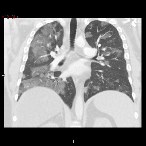 File:Non-specific interstitial pneumonitis (Radiopaedia 27044-27222 Coronal lung window 31).jpg