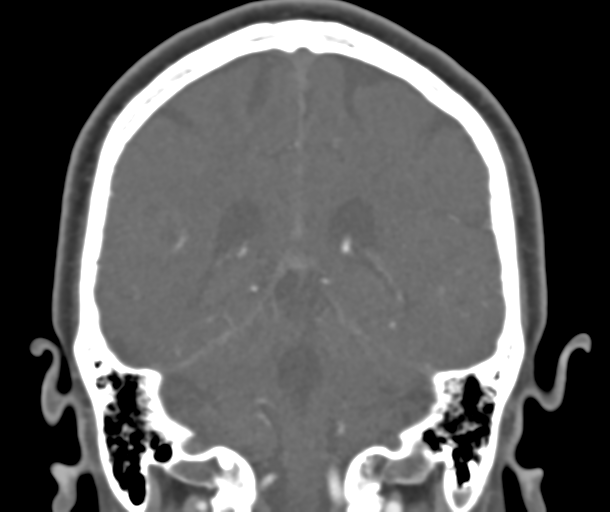 File:Normal CTA head (Radiopaedia 40801-43464 B 65).png