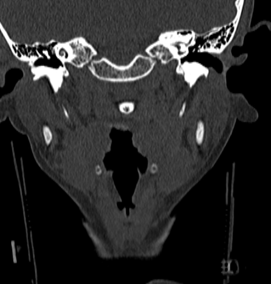 File:Normal CT cervical spine - 12-year-old (Radiopaedia 55352-61775 Coronal bone window 19).jpg