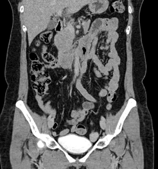 Normal CT intravenous urogram (Radiopaedia 39444-41759 A 243).jpg