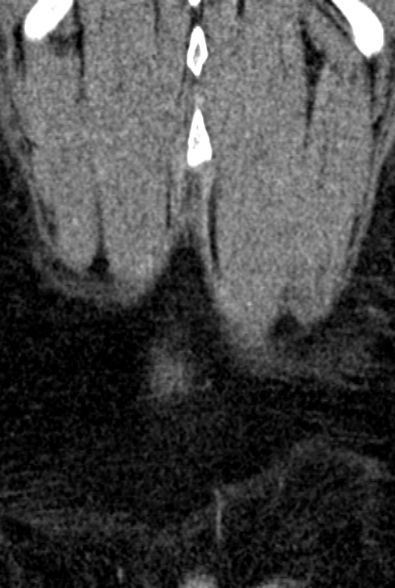 Normal CT lumbar spine (Radiopaedia 53981-60118 F 102).jpg