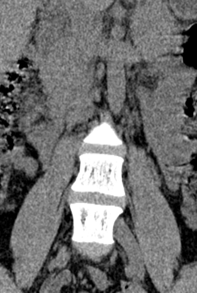 Normal CT lumbar spine (Radiopaedia 53981-60118 F 11).jpg