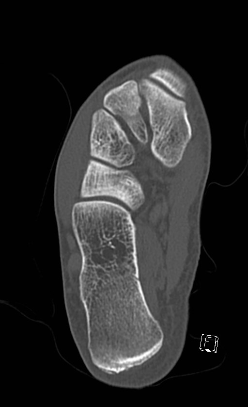 Normal CT of the ankle (Radiopaedia 47111-51658 Axial bone window 72).jpg