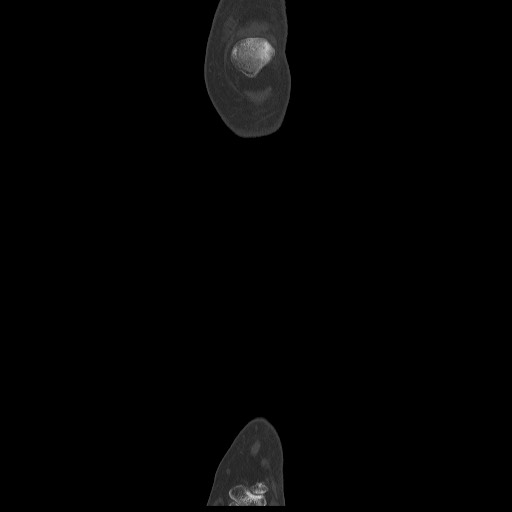 Normal CT tibia and fibula (Radiopaedia 51195-56848 Coronal non-contrast 16).jpg