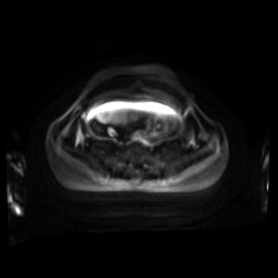 Normal MRI abdomen in pregnancy (Radiopaedia 88001-104541 Axial DWI 57).jpg