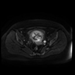 Normal MRI abdomen in pregnancy (Radiopaedia 88005-104548 Axial DWI 55).jpg