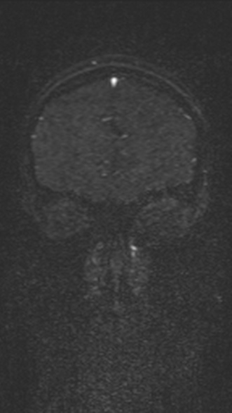 Normal MRI brain with MRV- teenager (Radiopaedia 49425-54553 Coronal MRV 55).jpg