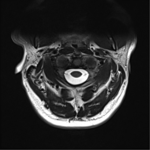 File:Normal MRI cervical spine (infection protocol) (Radiopaedia 53916-60039 Axial T2 11).png