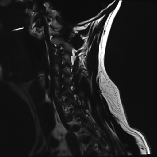 File:Normal MRI cervical spine (infection protocol) (Radiopaedia 53916-60039 F 14).png