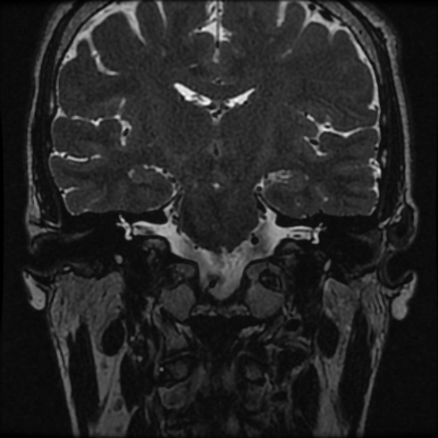 Normal MRI petrous (Radiopaedia 91317-108949 Coronal T2 47).jpg