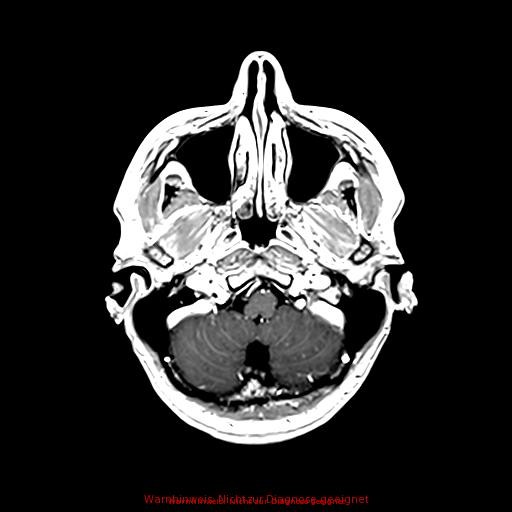 Normal adult brain MRI (non-enhanced and contrast-enhanced) (Radiopaedia 75262-86379 Axial T1 C+ 51).jpg