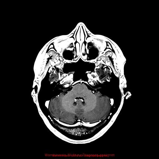 Normal adult brain MRI (non-enhanced and contrast-enhanced) (Radiopaedia 75262-86379 Axial T1 C+ 69).jpg
