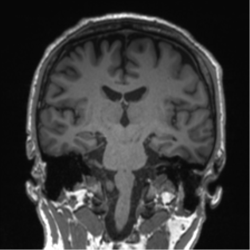 Normal brain MRI (non-focal epilepsy protocol) (Radiopaedia 53917-60040 Coronal T1 33).png