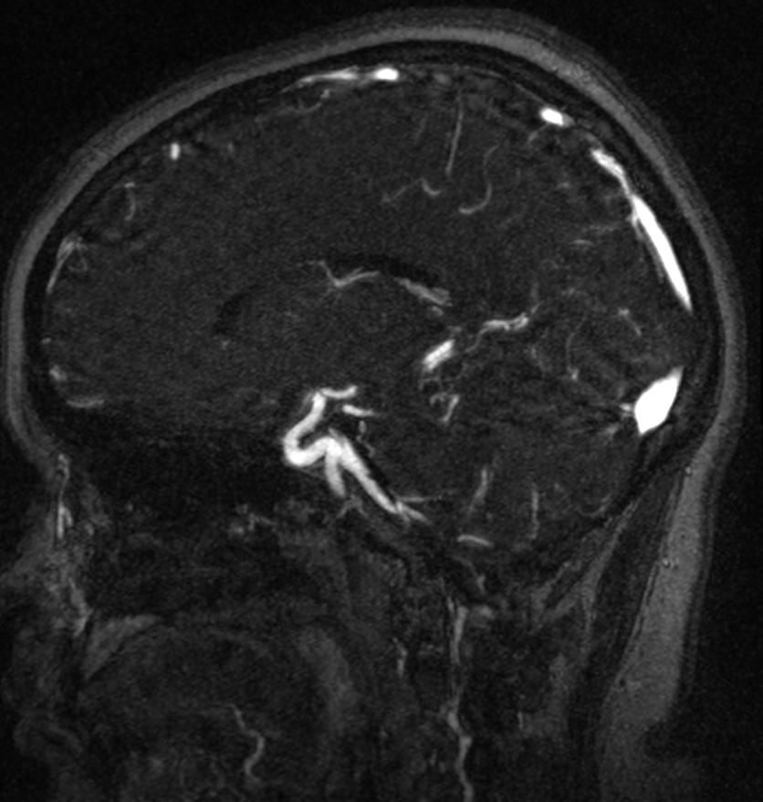 Normal brain MRI and venogram (Radiopaedia 39554-41862 Sagittal MRV 38).jpg