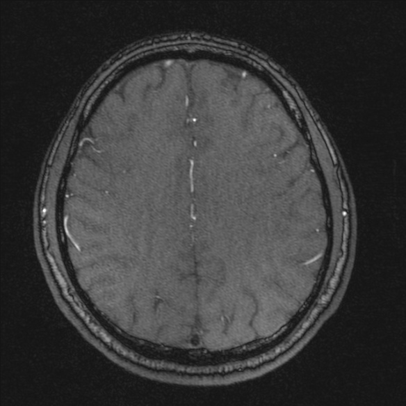 Normal brain MRI including MRA (Radiopaedia 48748-53763 Axial MRA 153).jpg