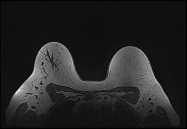 File:Normal breast MRI - dense breasts (Radiopaedia 80454-93850 Axial T1 174).jpg