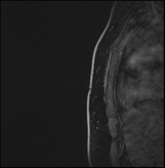Normal breast MRI - dense breasts (Radiopaedia 80454-93850 I 184).jpg
