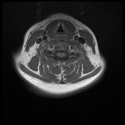 File:Normal cervical and thoracic spine MRI (Radiopaedia 35630-37156 Axial T1 17).png