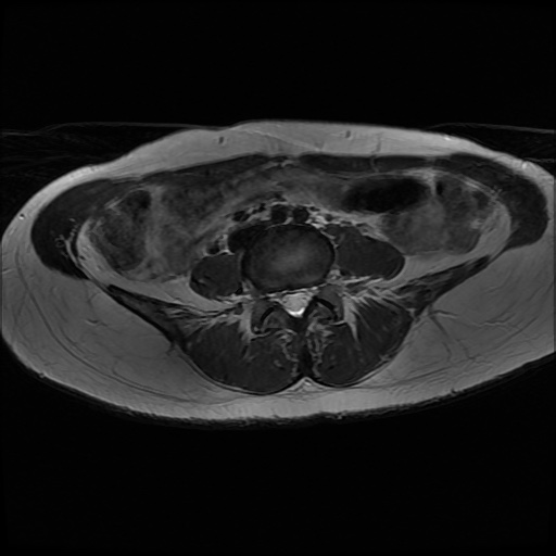 File:Normal female pelvis MRI (retroverted uterus) (Radiopaedia 61832-69933 Axial T2 1).jpg