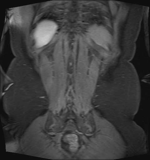 File:Normal hepatobiliary phase liver MRI (Radiopaedia 58968-66230 B 4).jpg