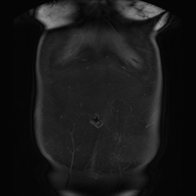 Normal liver MRI with Gadolinium (Radiopaedia 58913-66163 P 7).jpg