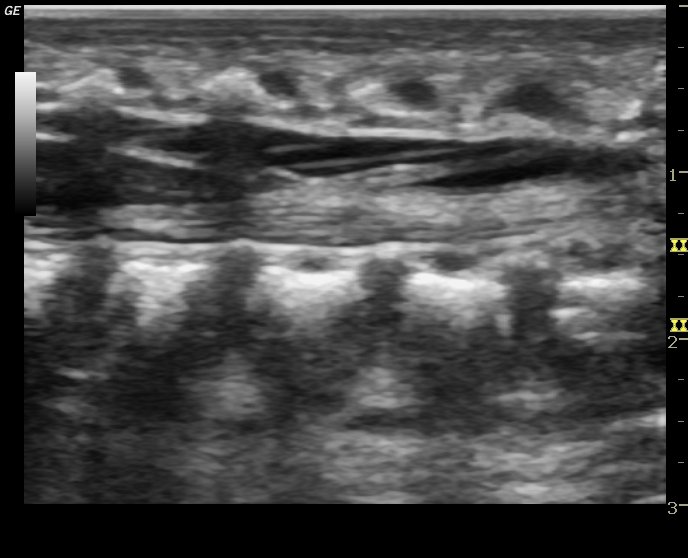 File:Normal neonatal spinal canal on ultrasound (Radiopaedia 34886-36353 C 1).jpg