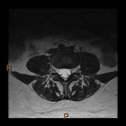 File:Normal spine MRI (Radiopaedia 77323-89408 Axial T2 14).jpg