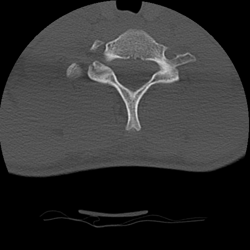 File:Normal trauma spine imaging (age 16) (Radiopaedia 45335-49358 Axial bone window 63).jpg