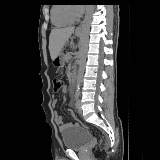 File:Obstructed kidney with perinephric urinoma (Radiopaedia 26889-27066 B 34).jpg