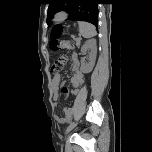 File:Obstructed kidney with perinephric urinoma (Radiopaedia 26889-27066 B 49).jpg