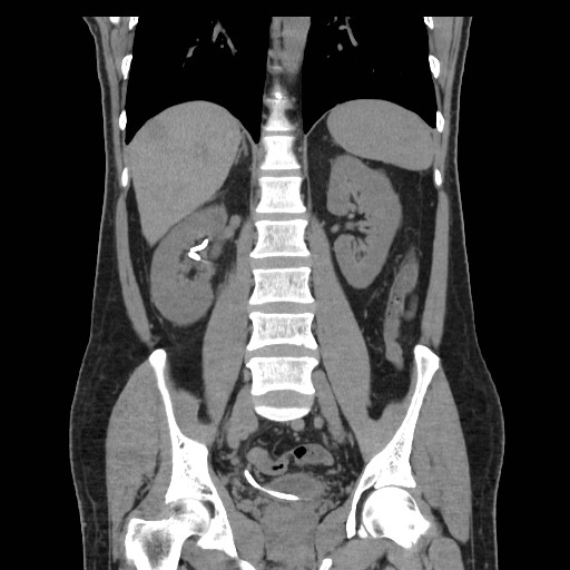 File:Obstructed kidney with perinephric urinoma (Radiopaedia 26889-27067 Coronal non-contrast 14).jpg