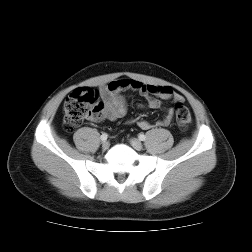 File:Obstructing ureteric calculus (Radiopaedia 18615-18514 B 40).jpg