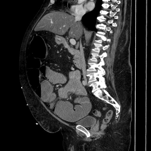 Obstructive colonic diverticular stricture (Radiopaedia 81085-94675 C 115).jpg