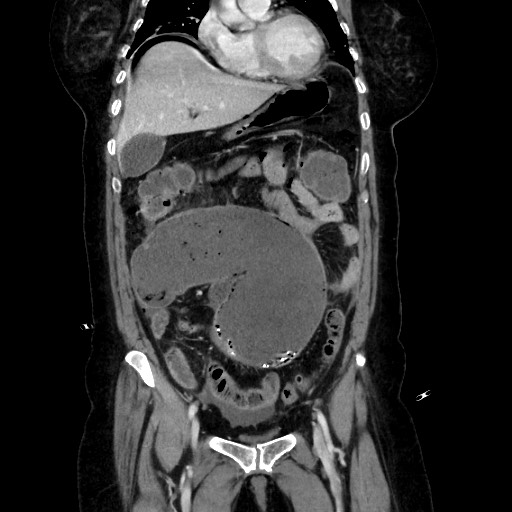 Obstructive distal colonic adenocarcinoma causing cecal perforation (Radiopaedia 86830-102989 C 76).jpg